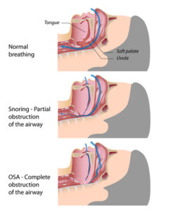 nasal obstruction diagram 