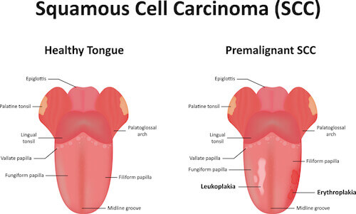 Diagram of Squamous Cell Carcinoma